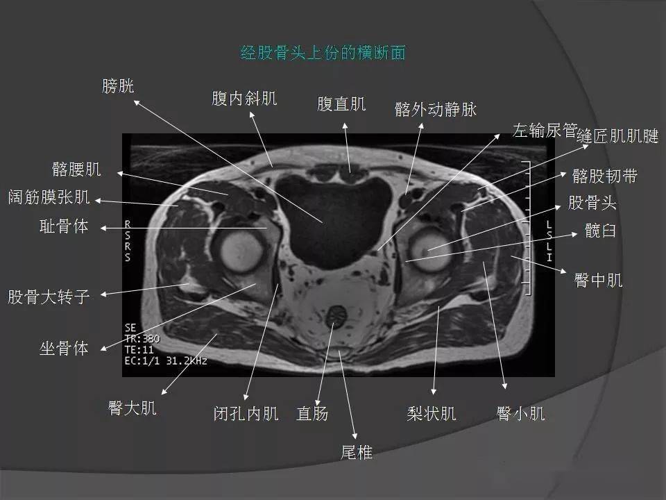 骨盆肌肉解剖mri标识