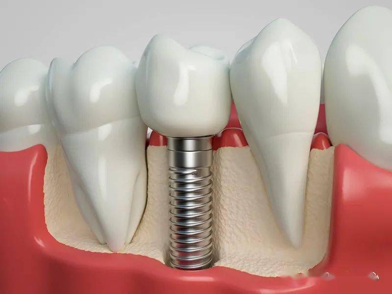 种植技术是一种牙齿缺失的修复方法