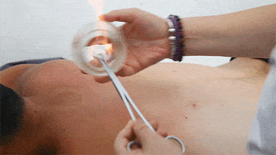 一看就会手把手教你拔罐拔罐大全