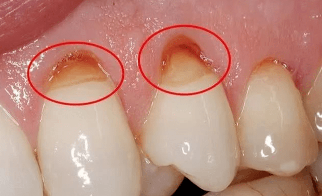 如果长时间的横向刷牙会造成牙颈部严重磨损,形成牙齿楔状缺损