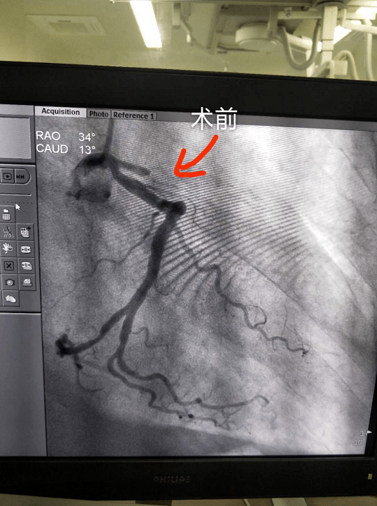 【临床一线】永春县总医院开展急诊pci成功挽救急性心梗患者_冠脉