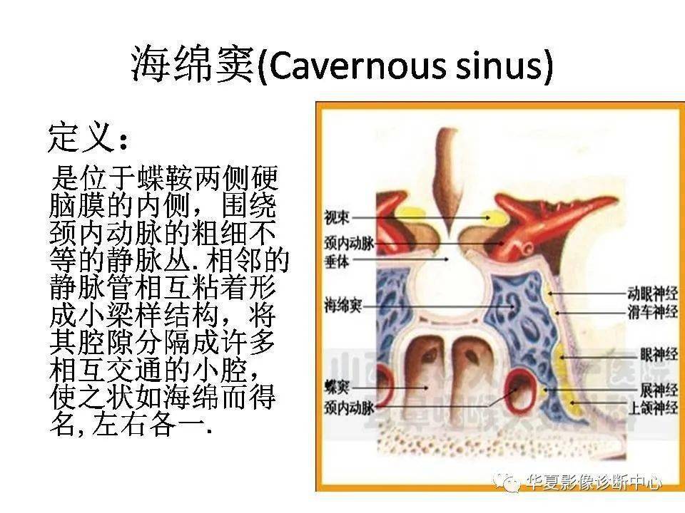 颈内动脉海绵窦瘘图片