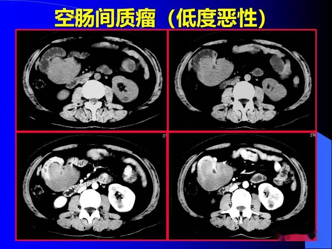 肠道肿瘤ct图片