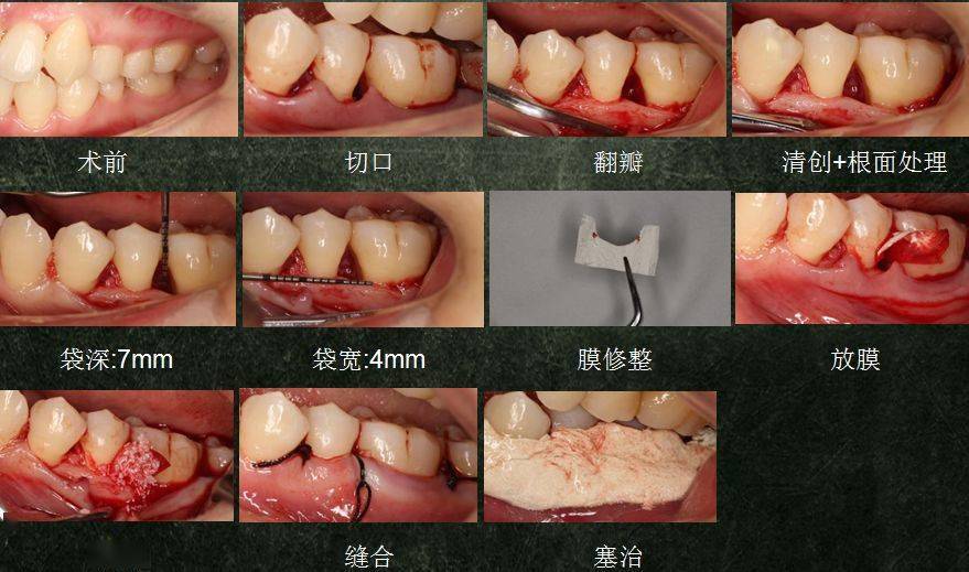 侷限型侵襲性牙周炎及牙齦退縮治療病例分享