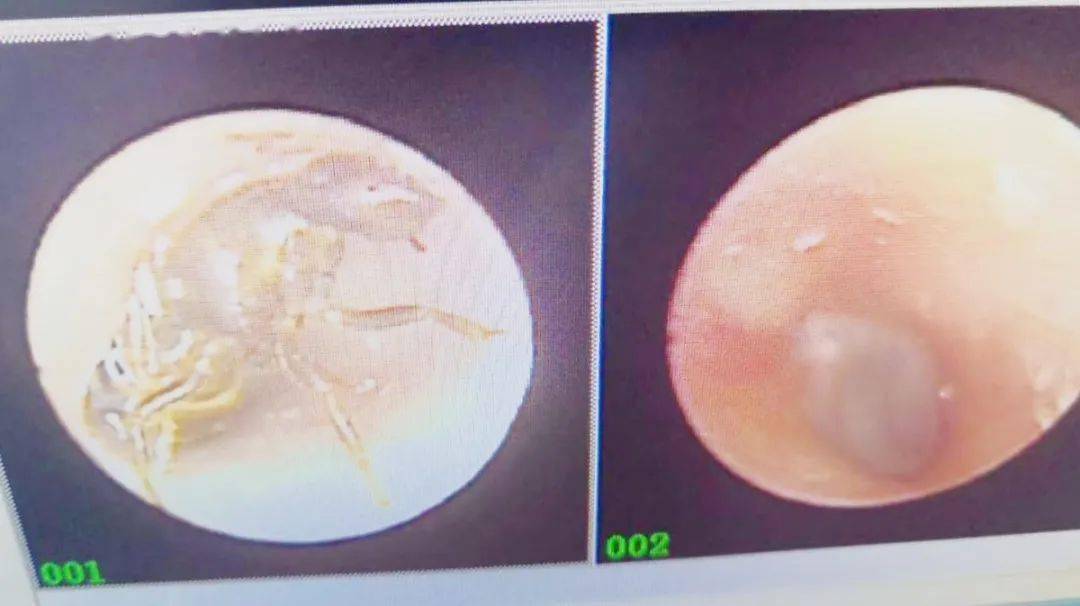 在内镜室,刁护士用耳内镜检查,发现贴近鼓膜处有一白色异物,用专用