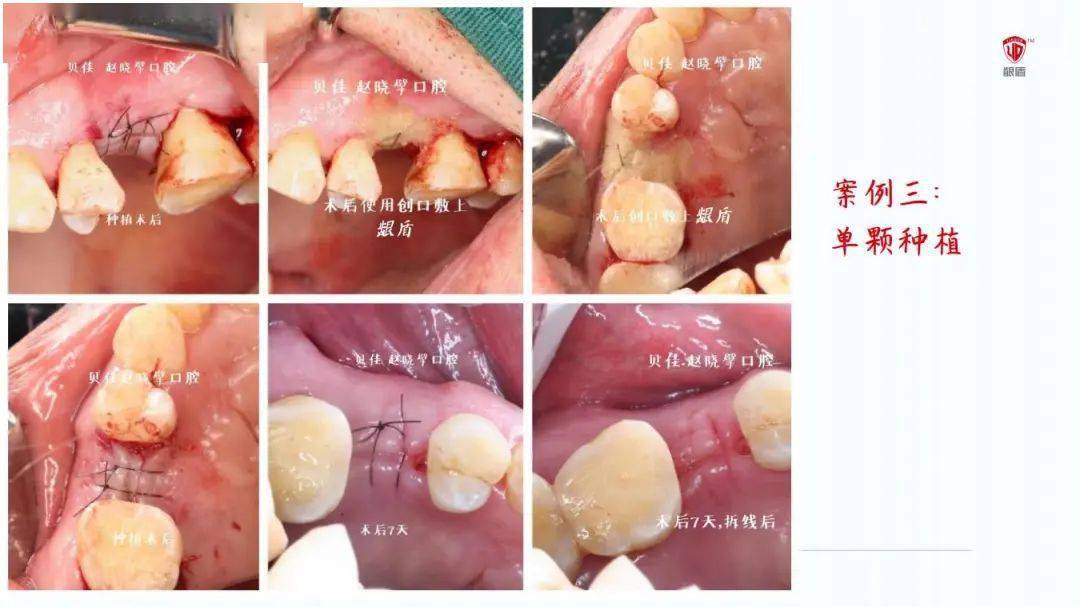 如何在拔牙后促进牙龈伤口愈合