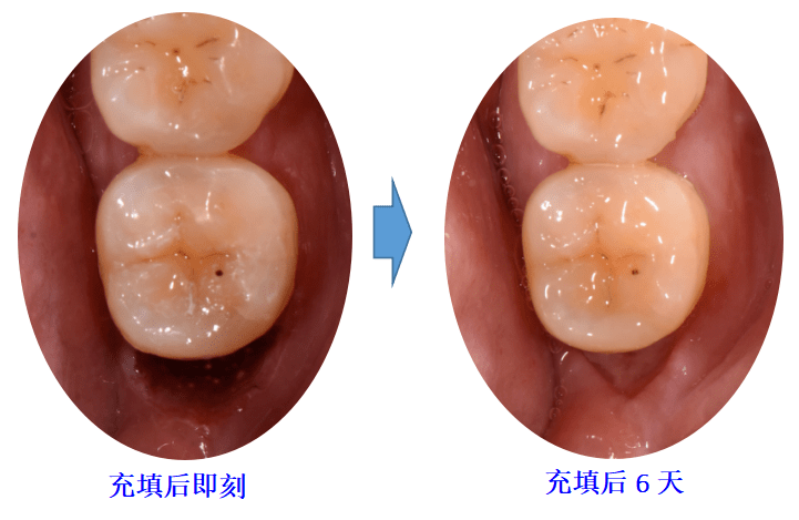 【病例】磨牙远中龈下龋洞对根管治疗的影响及处理办法