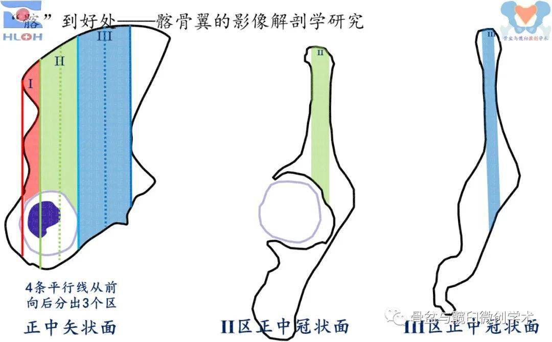 醫工結合為創新仁心匠心乃本心保留髂嵴的半自動化髂骨翼取骨器械的