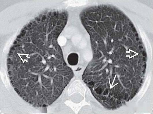 全小葉型/間隔旁型肺氣腫丨ct診斷要點