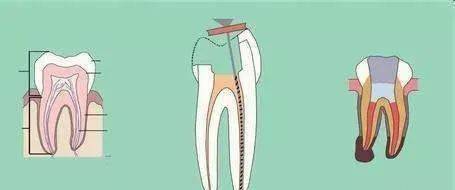 盤點根管治療的技術要點及失敗後的再治療