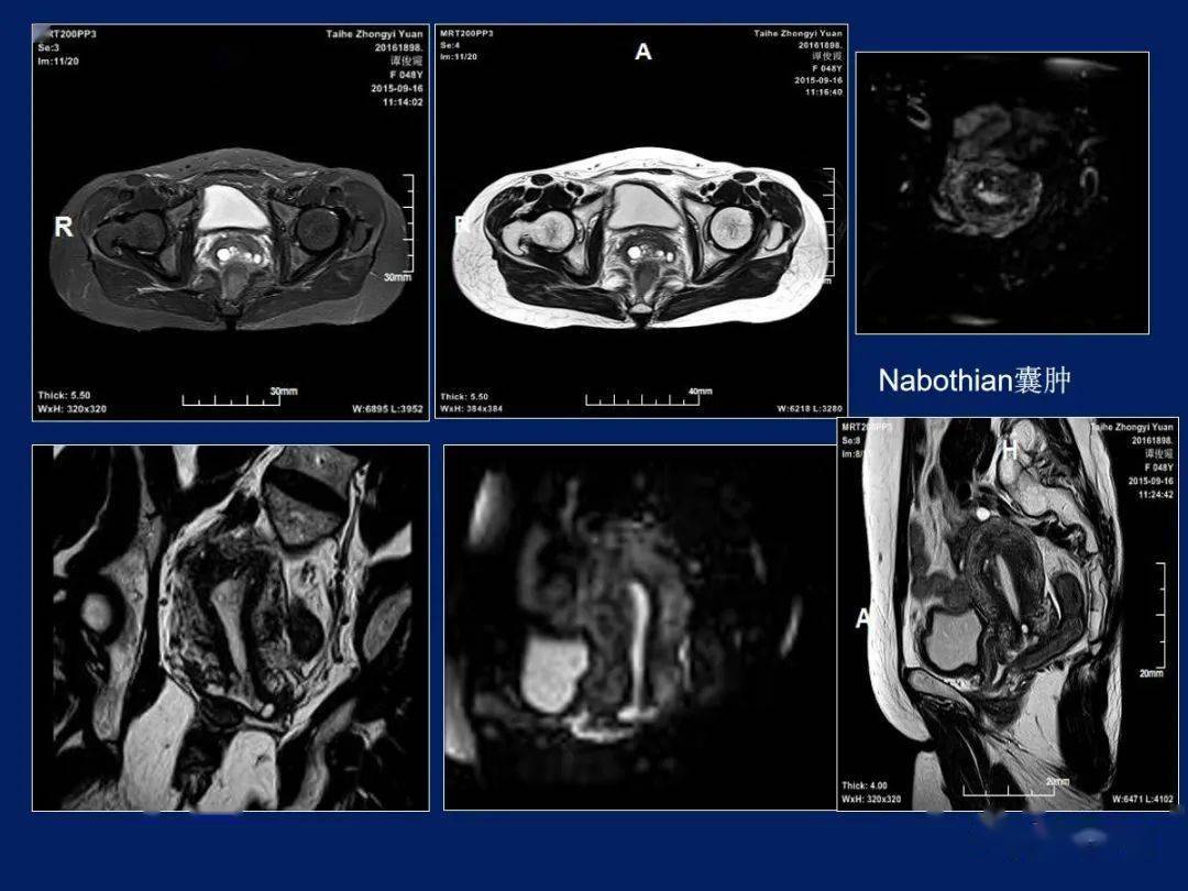 病变--子宫颈癌病理上分4型1,外生型 ,肿块向子宫颈外生长,呈菜花状2