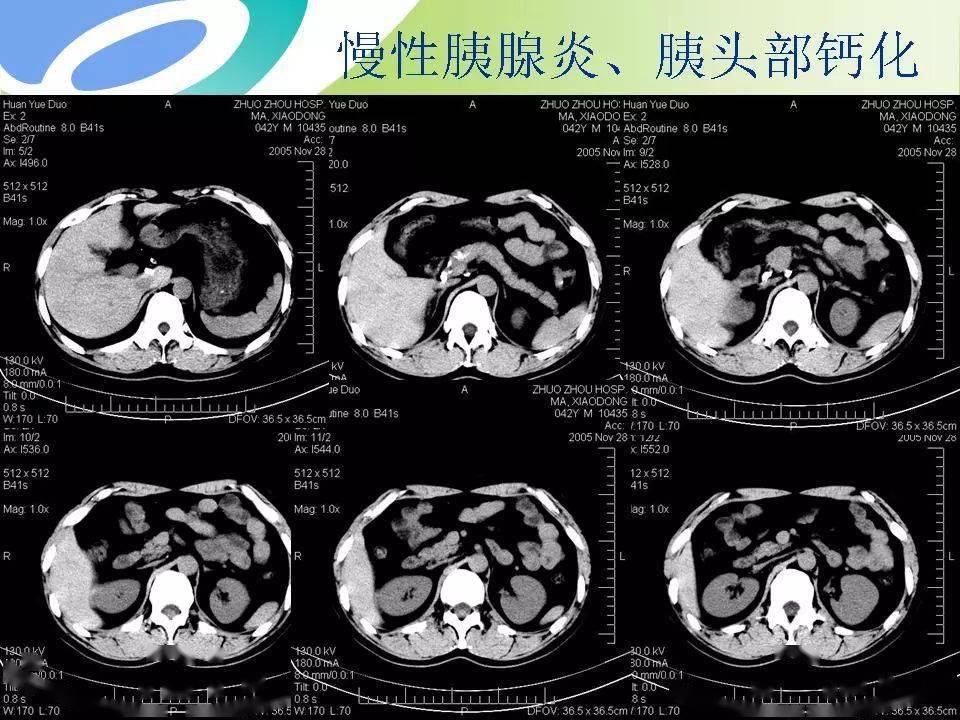 胰腺癌的影像诊断