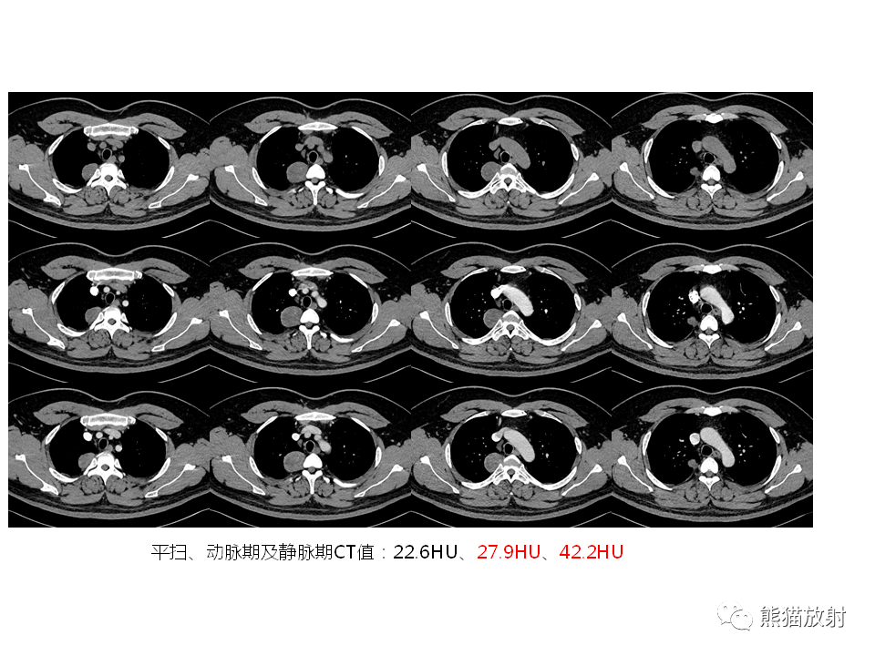 省立影像读片后纵隔肿瘤2009