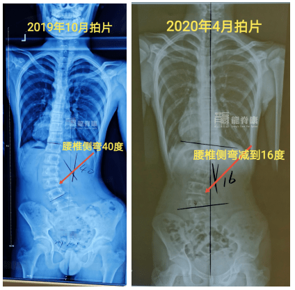 面对75°以下的大角度脊柱侧弯