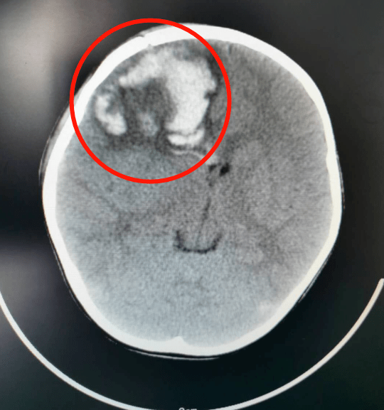 中山一4岁女童独自在家高处坠落后颅内出血