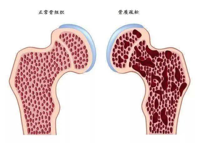 短视频过了35岁骨量就会降低真相是