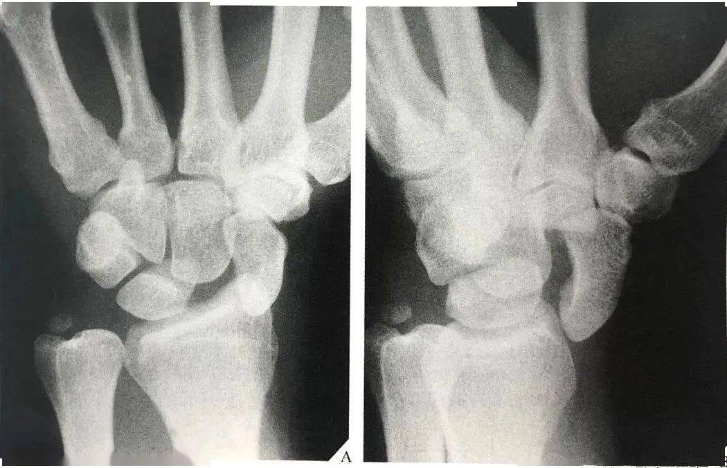 舟骨脫位合併橫軸向腕破裂腕關節背掌位x線片顯示舟骨向橈掌側脫位(彎