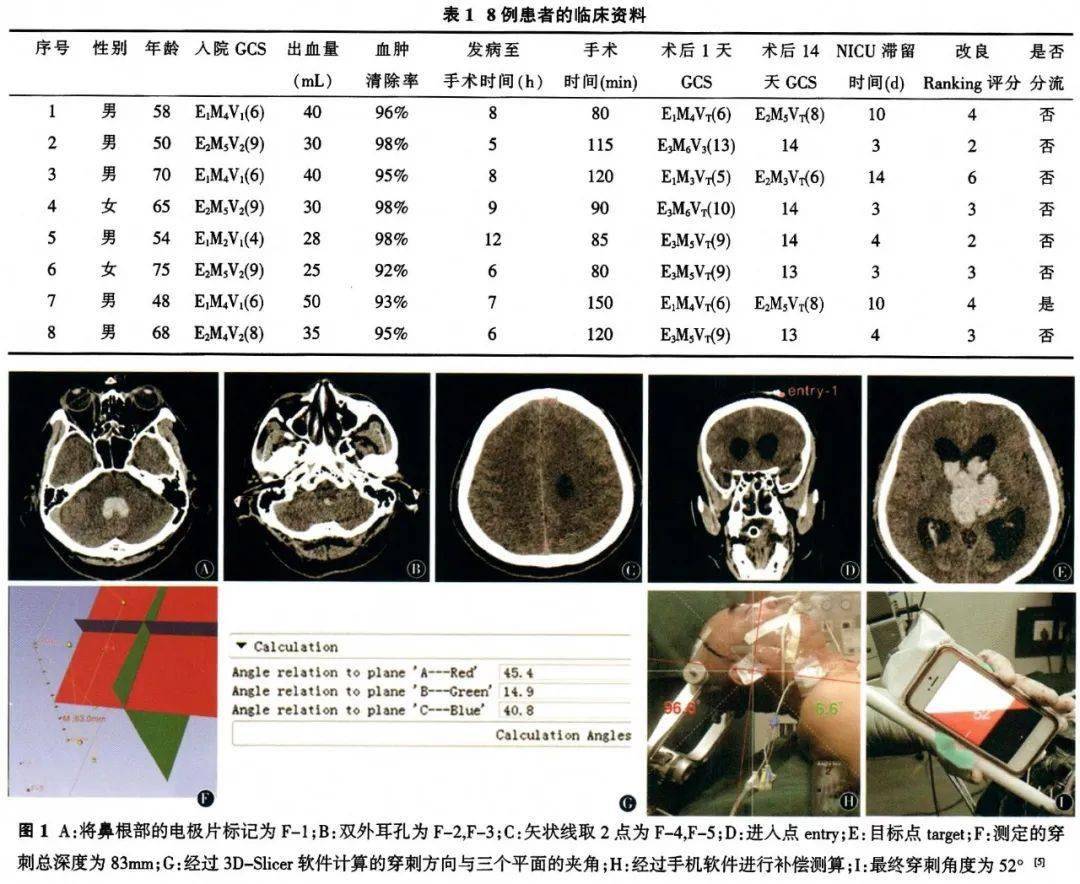 研究| 简易导航下神经内镜经kocher点额中回放路微创手术治疗丘脑出血