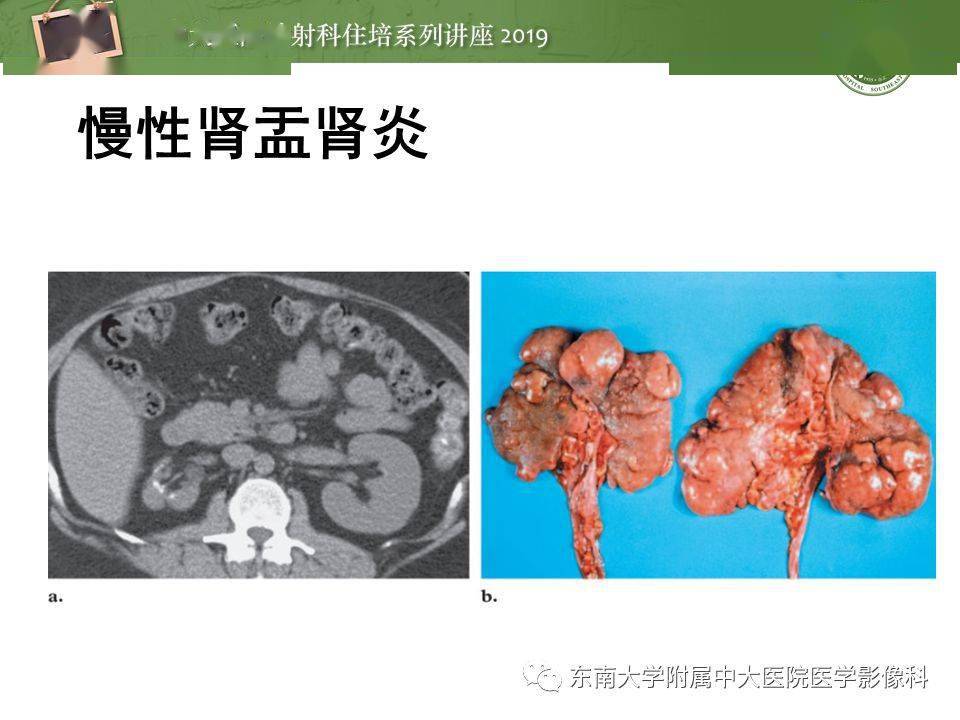 肾脏感染性病变的影像学表现