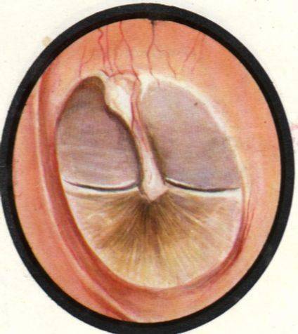 科普如何诊治分泌性中耳炎看这篇就够了