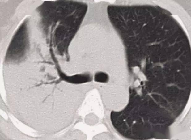 肺部疾病的ct征象