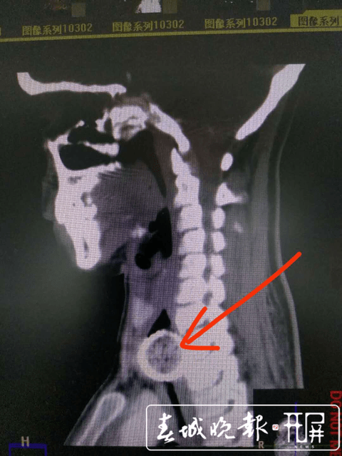 于是,她到广州某医院就诊,检查后发现,她的食管颈—胸交界段有一个
