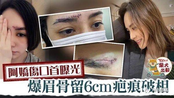 阿嬌縫線傷口照首曝光!撲爆眉骨留