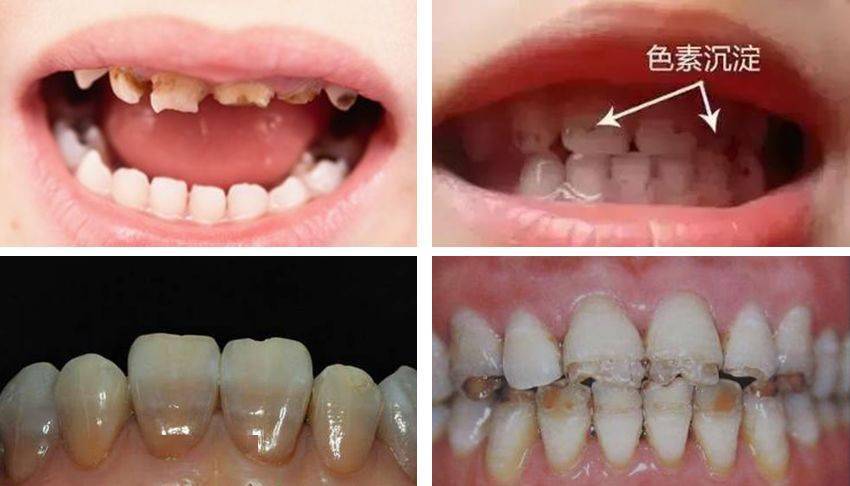 儿童牙齿涂氟前后图片图片
