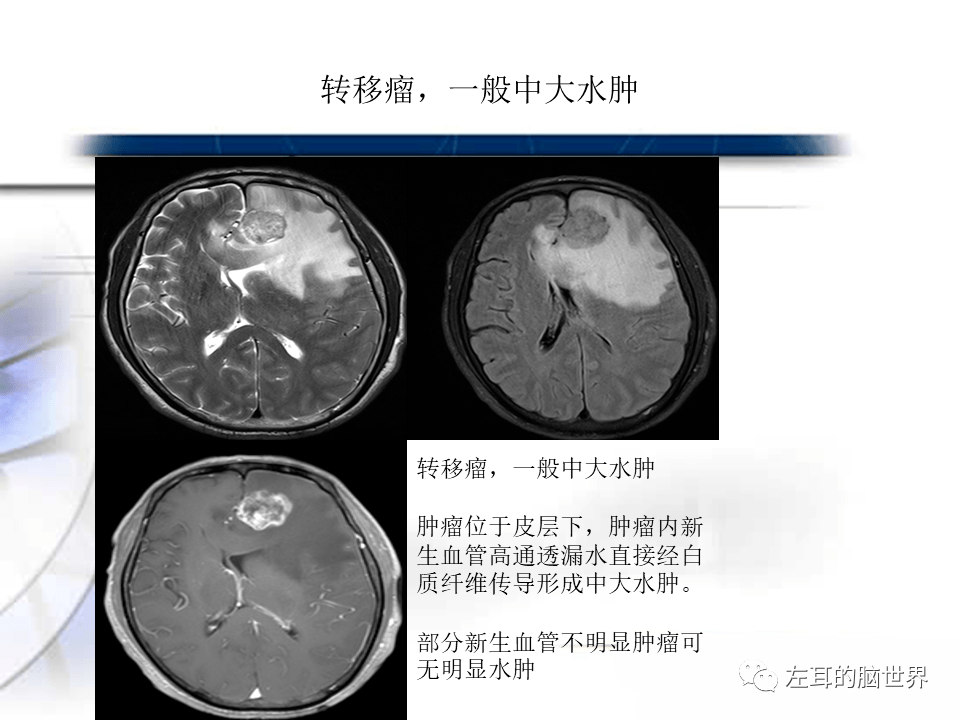脑肿瘤基础 | 血脑屏障,强化,水肿