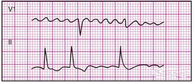 通常显示体表心电图不规则波动(f波),v1中最明显;p波缺失 ,室性心律
