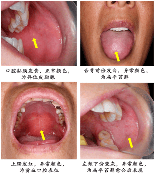 口腔黏膜皮脂腺异位图片