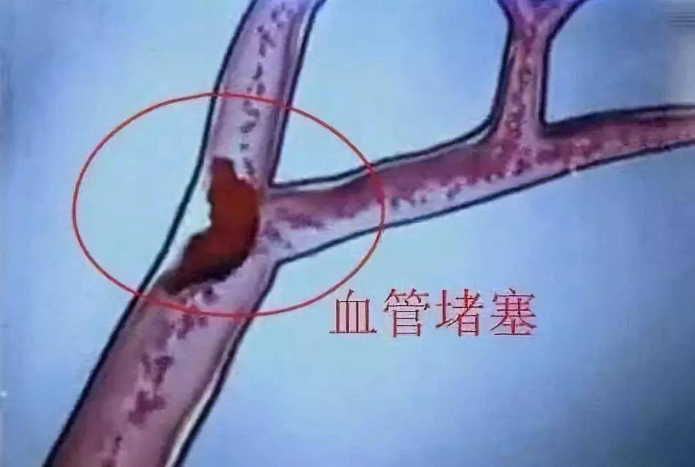 血管堵了93岁院士说坚持这么做可以少往医院跑