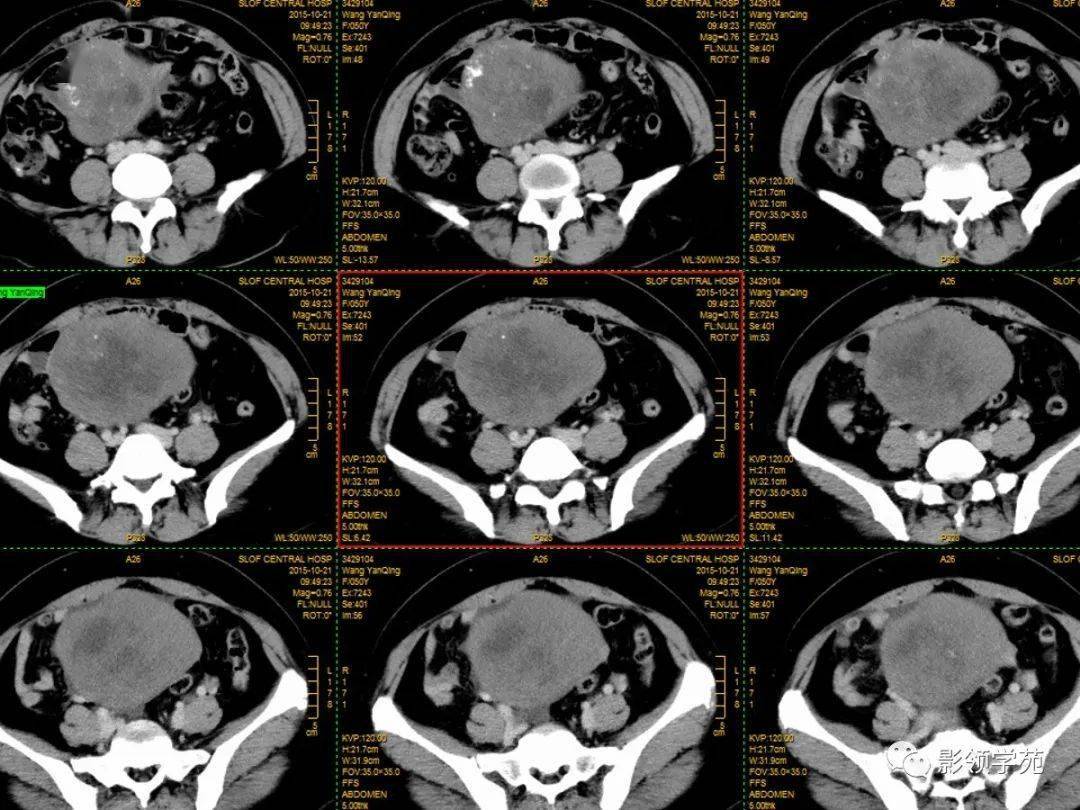 盆腔ct平扫图片