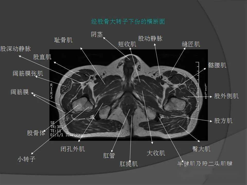 腰部肌肉断层解剖图图片