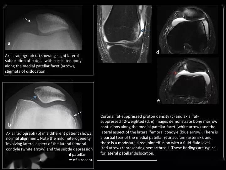 2提示高位髕骨);b圖pt/pl比值為1.8;c圖示髕骨脫位狀態,局部骨髓水腫.