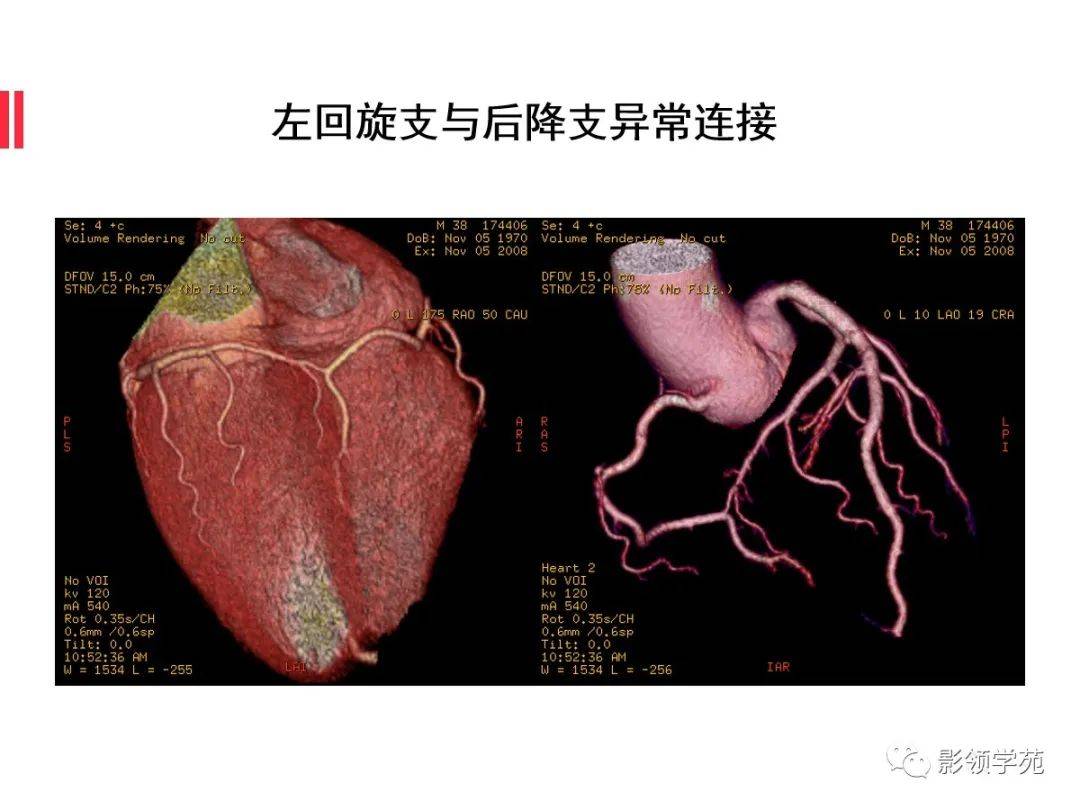 冠状动脉CTA图解图片