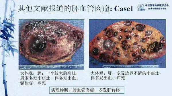 病例81期鄭堃原發性脾血管肉瘤伴肝血管瘤一例