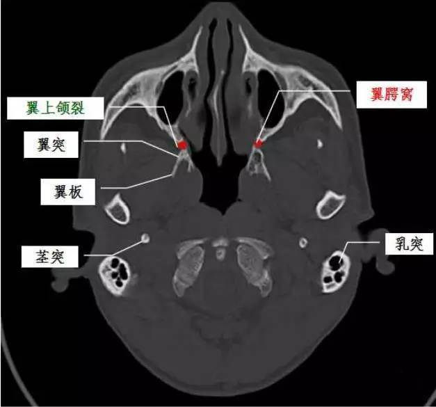 上颌骨ct图片