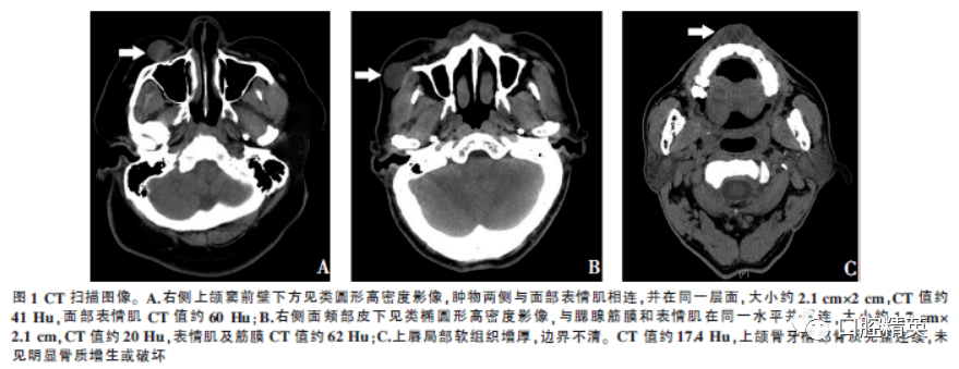 口腔頜面部肌內型結節性筋膜炎3例報告及文獻複習