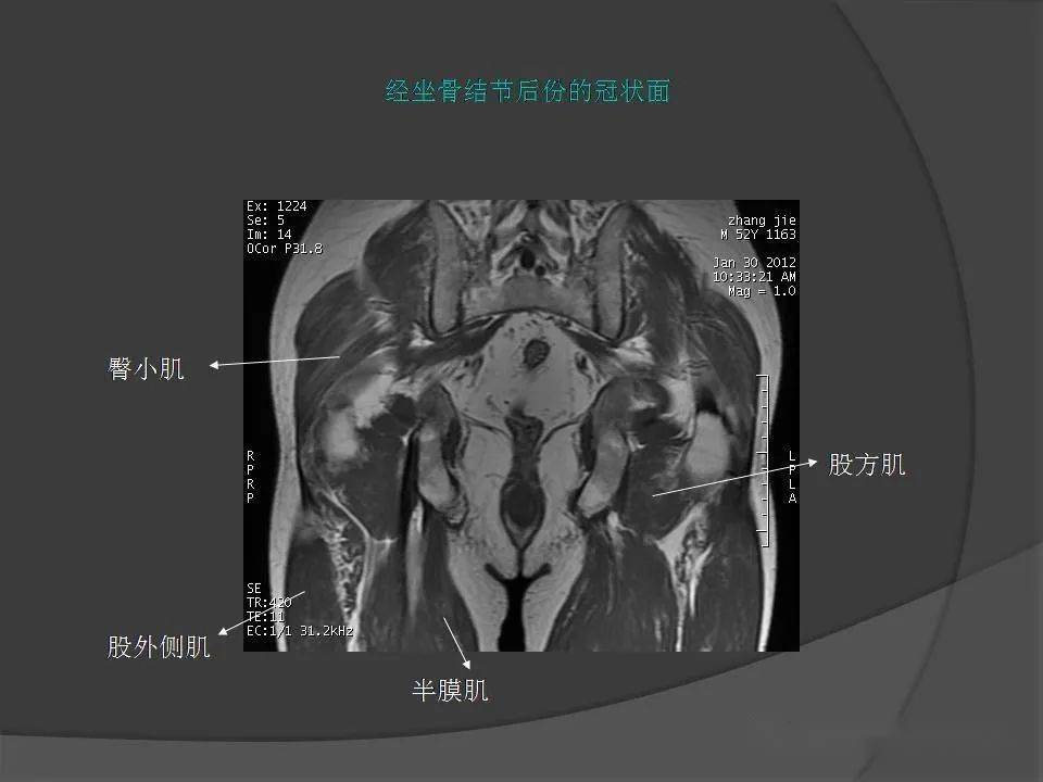 骨盆肌肉mri断层解剖