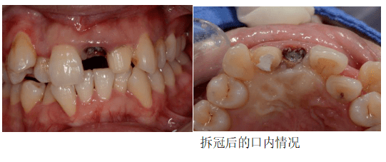 病例上頜前牙殘根拔除後位點保存