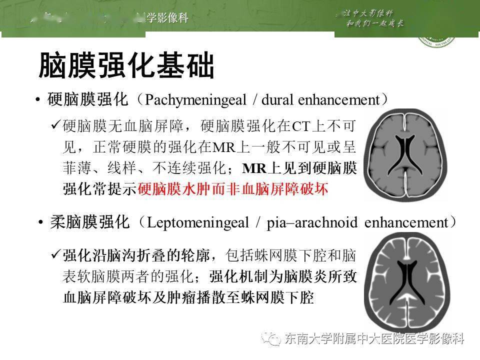 脑膜尾征你不会只知道脑膜瘤吧