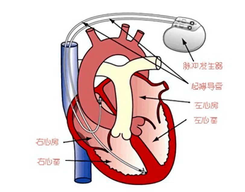 【妍论健康】自测脉搏可尽早发现起搏器异常!