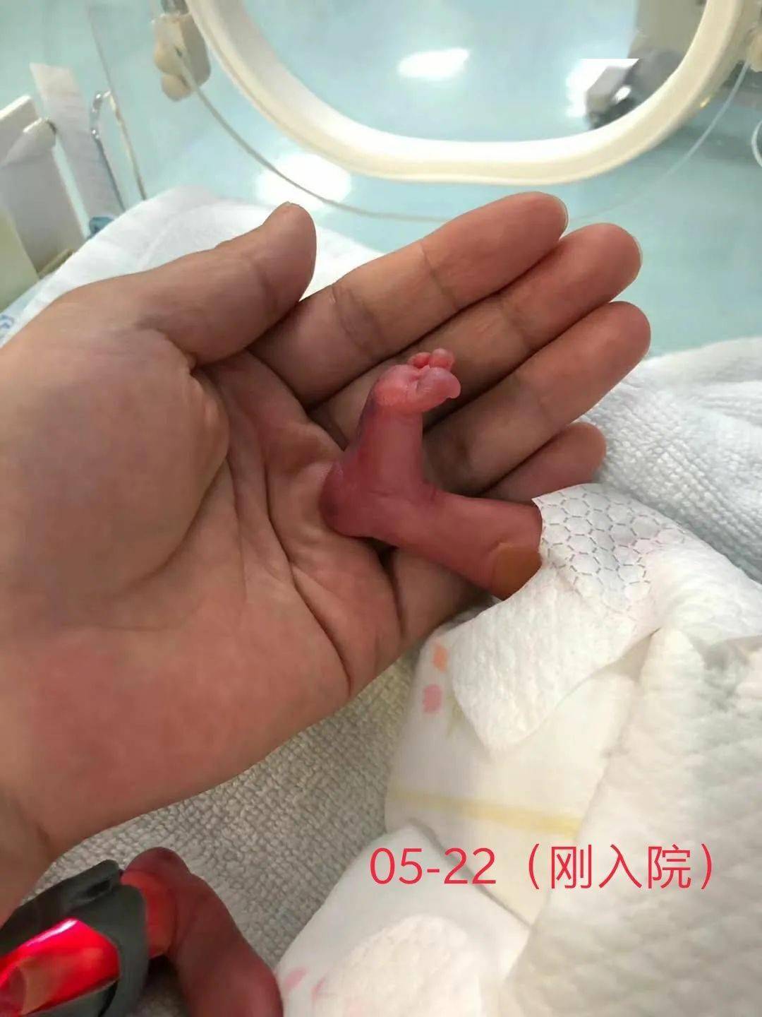 一路闯关出生仅600克的双胎小妹在苏州九龙医院救治成功顺利出院