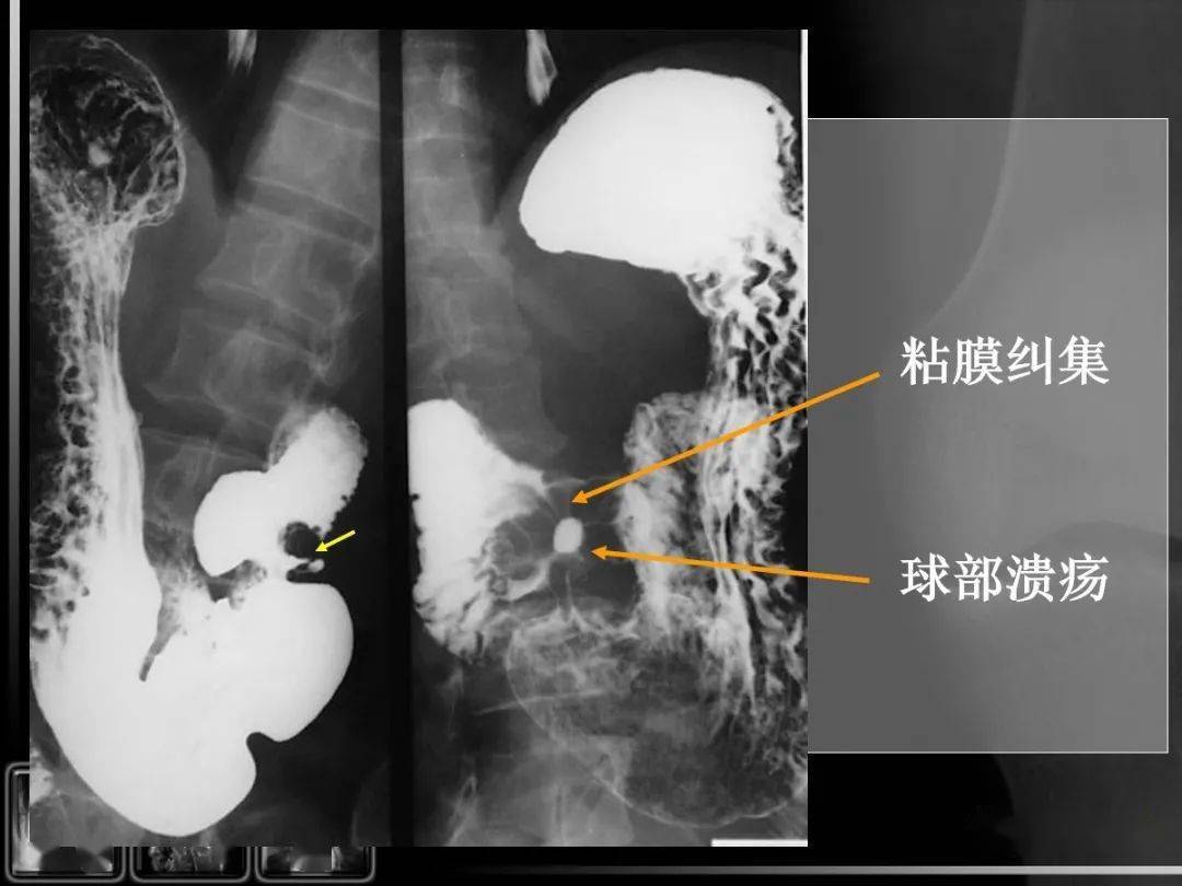 小腸位置,分佈異常,活動度增大4)先天性固定不良或位置異常遊走盲腸