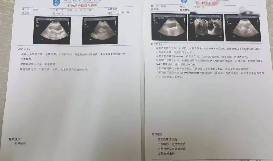 女性健康婦科檢查做個b超就可以了嗎這幾個項目一個都不能少