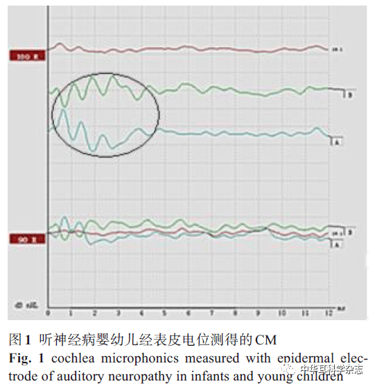 耳蜗微音电位在诊断婴幼儿听神经病中的应用