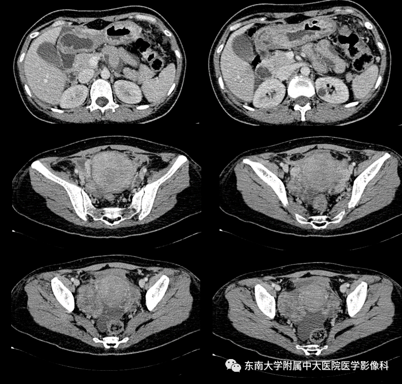 病史 女,40岁,因"确诊胃窦低分化腺癌5月余"入院 ct 增强