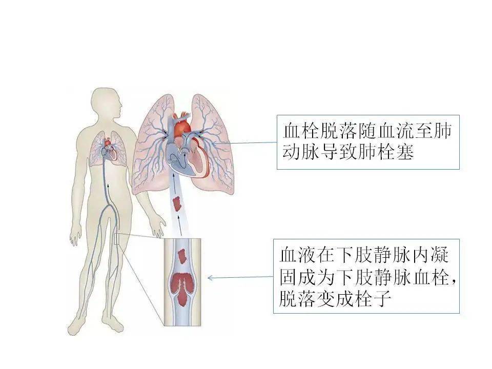 空气栓塞的部位图片图片