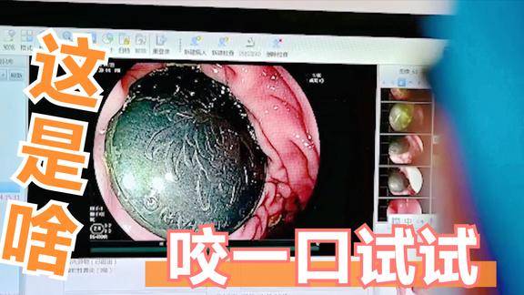 硬币纽扣电池磁珠等异物不慎被宝宝吞下家长切不可这样做